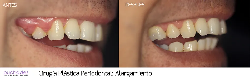 Cirugía plástica periodontal, caso 6: antes y después