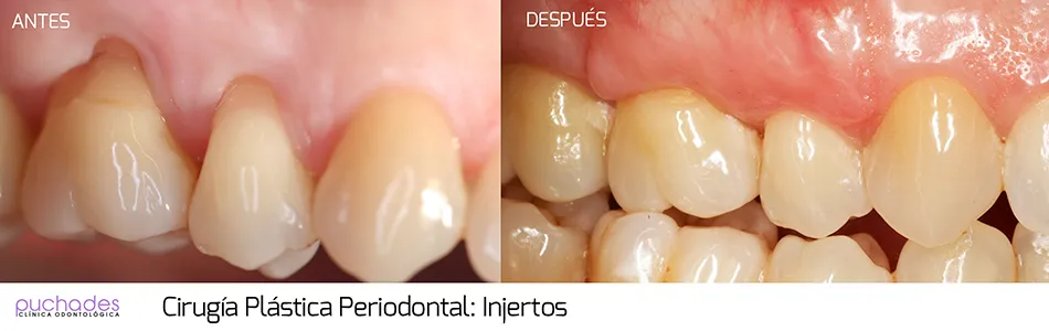 Cirugía plástica periodontal, caso 1: antes y después