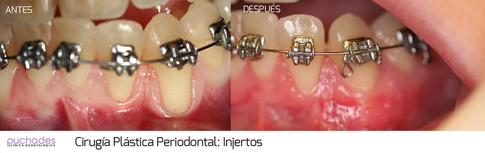 Cirugía plástica periodontal, caso 3: antes y después