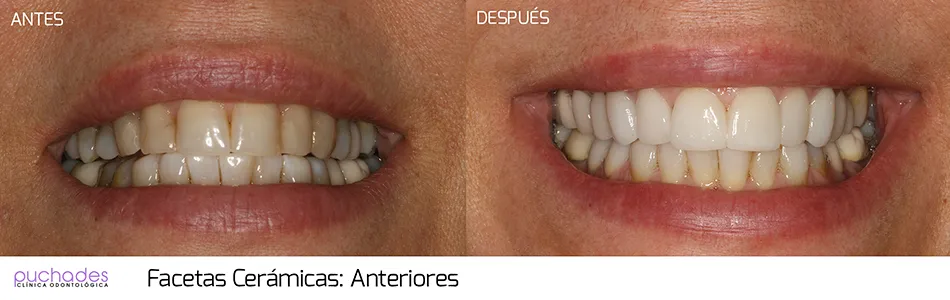 Facetas cerámicas, caso 1: antes y después