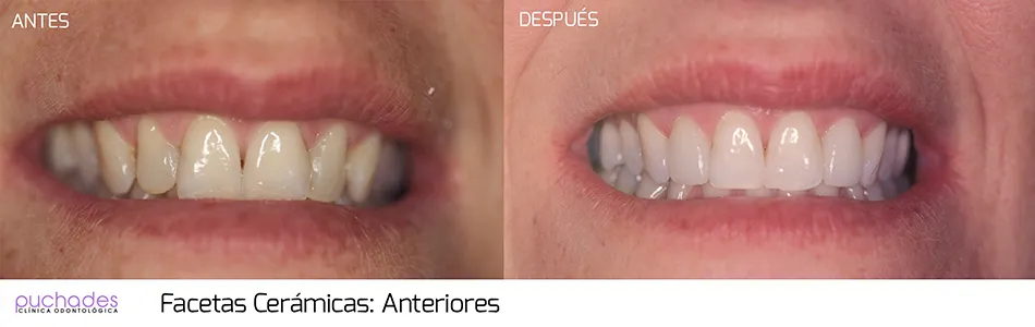 Facetas cerámicas, caso 2: antes y después
