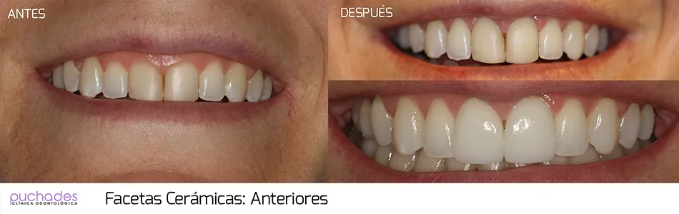 Facetas cerámicas, caso 3: antes y después