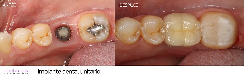 Implantes dentales, caso 3: antes y después