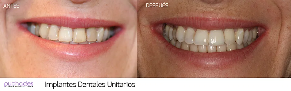 Implantes dentales, caso 1: antes y después