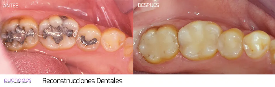 Reconstrucciones dentales, caso 4: antes y después