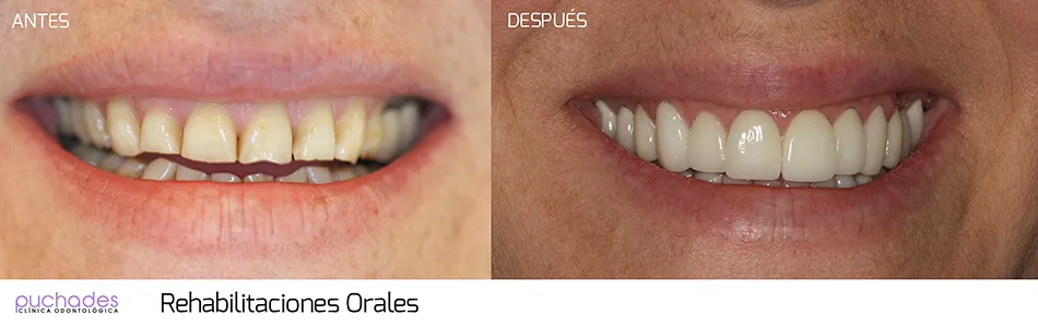 Rehabilitaciones orales, caso 2: antes y después